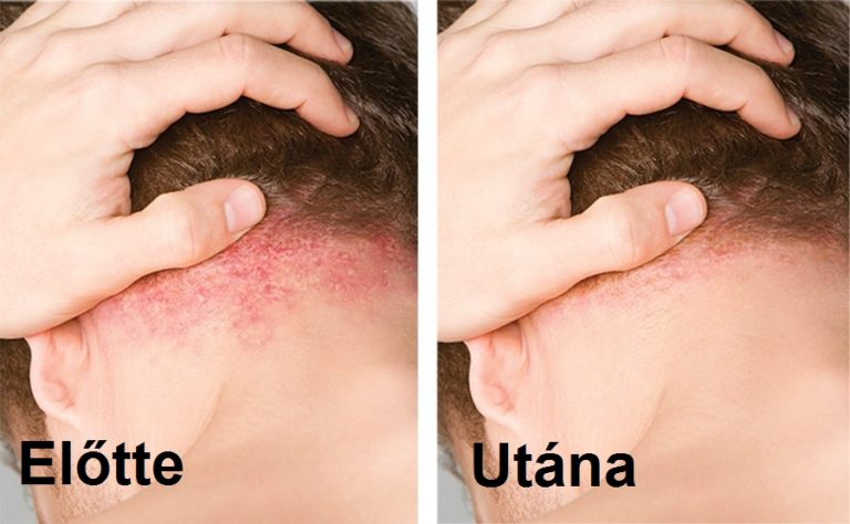 psoriasis treatment lifestyle changes